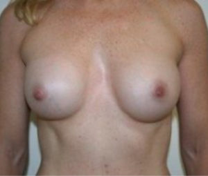 DC Breast Augmentation