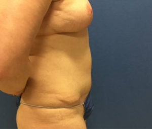 Tummy tuck side after