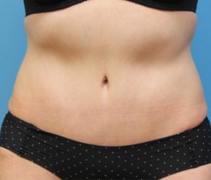 Tummy tuck front after