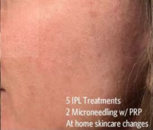 After-IPL-microneedling (1)