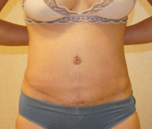 Tummy tuck front after