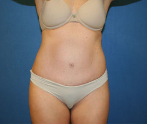 Tummy Tuck After