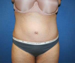 Tummy tuck front after