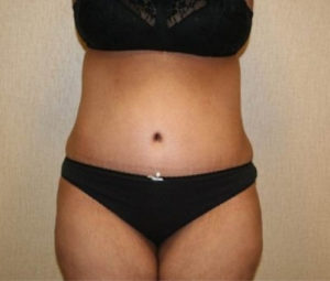 Tummy tuck front after