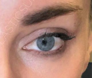 Dermal Fillers