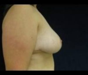 Breast reduction after