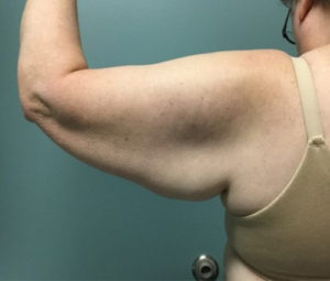 Armlift Before Back