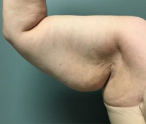 Arm Lift Before (Front Arm)