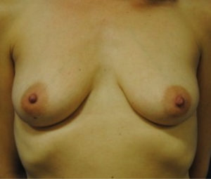 Breast Reconstruction