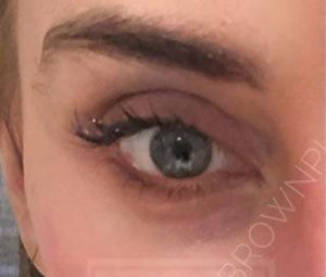 Dermal Fillers