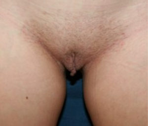 Labiaplasty Procedure DC