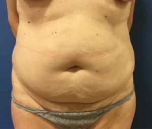Tummy tuck front before