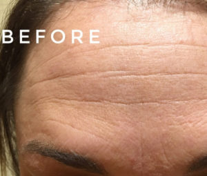 Botox Cosmetic Before