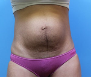 Tummy tuck front before