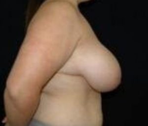 Breast reduction before