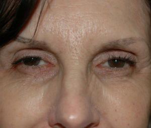 Blepharoplasty (Eyelid Surgery) DC