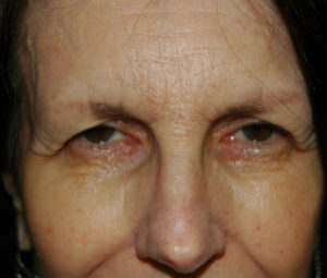 Blepharoplasty (Eyelid Surgery) DC