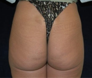 Brazilian Butt Lift before