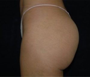 Brazilian Butt Lift from the side