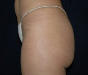 Brazilian Butt Lift Before Side
