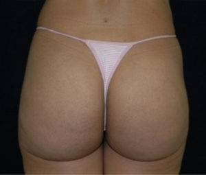 Brazilian Butt Lift after