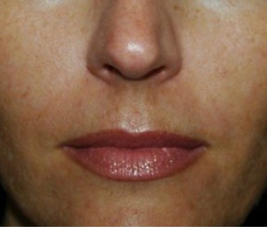 Dermal Fillers after