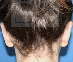 Ear pinning dc after
