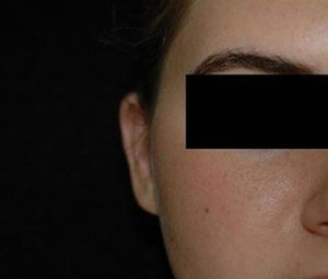 otoplasty Ear pinning dc after