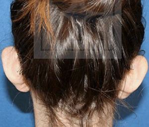 Ear pinning dc before