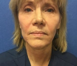 Facelift before