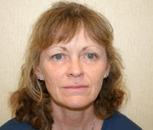 Facelift before
