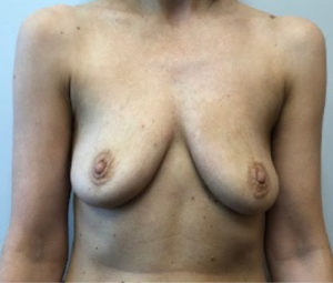Breast Augmentation