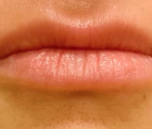 Dermal Fillers