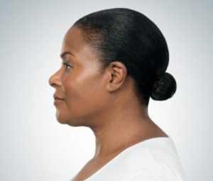 Kybella After Double Chin Reduction