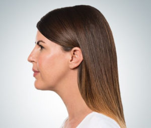 Kybella After Double Chin Reduction