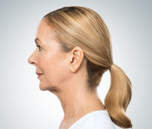 Kybella After Double Chin Reduction