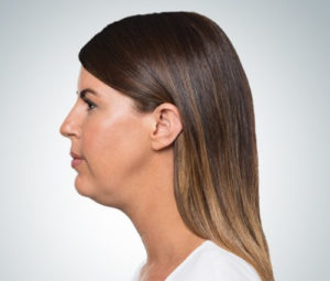 Kybella Before Double Chin Reduction