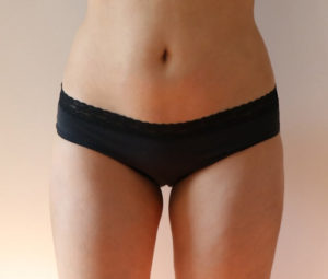 Laser Lipo