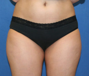 Laser Lipo