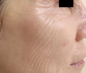 Micro-needling-DC-After-162 (1)