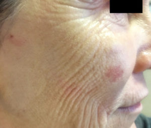 Micro-needling DC Before 162 (1)