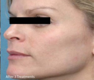 Microneedling-2b (1)