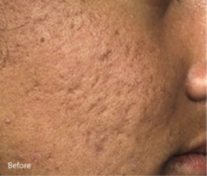 Microneedling-3a (1)