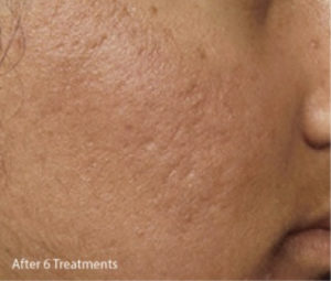 Microneedling-3b (1)