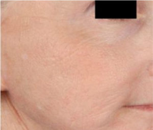 Microneedling1b (1)