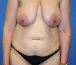 Mommy Makeover Plastic Surgery
