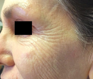 Microneedling with PRP vs PRP Injections