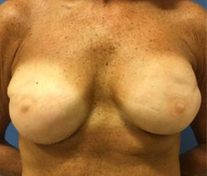 Pre-Pectoral-Breast-Reconstructionbefore3 (1)