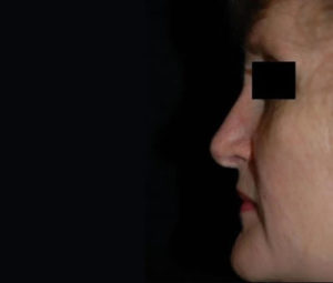 Rhinoplasty DC nose surgery after