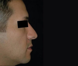 Rhinoplasty DC nose surgery after